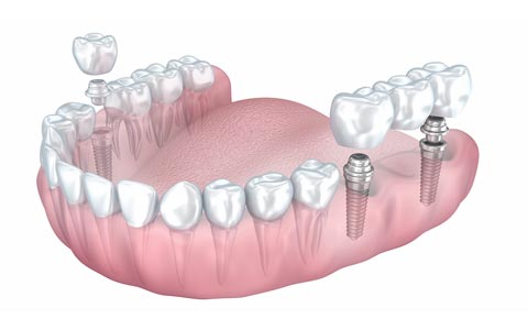 dental implant and crown, implant bridge
