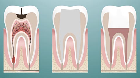 root canal process